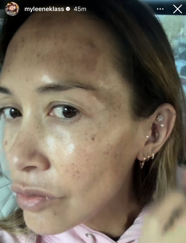 Myleene Klass explains her extra freckly face- she had IPL