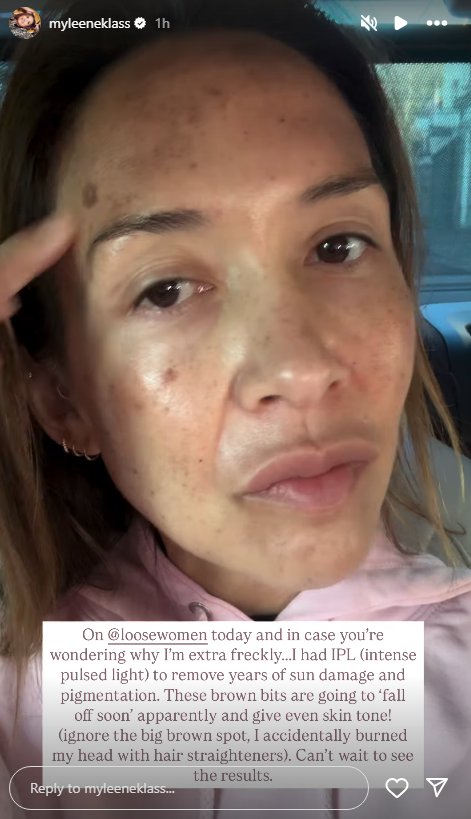 Myleene Klass has IPL facial